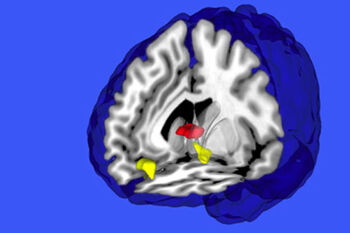 Bilde av en hjerne og enkelte fargede områder.
